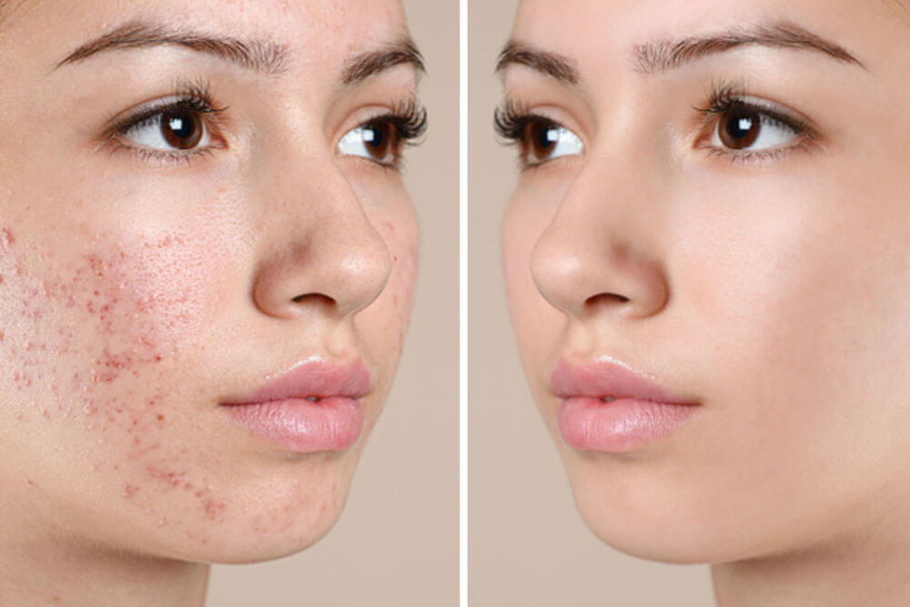 Teenage girl before and after acne treatment