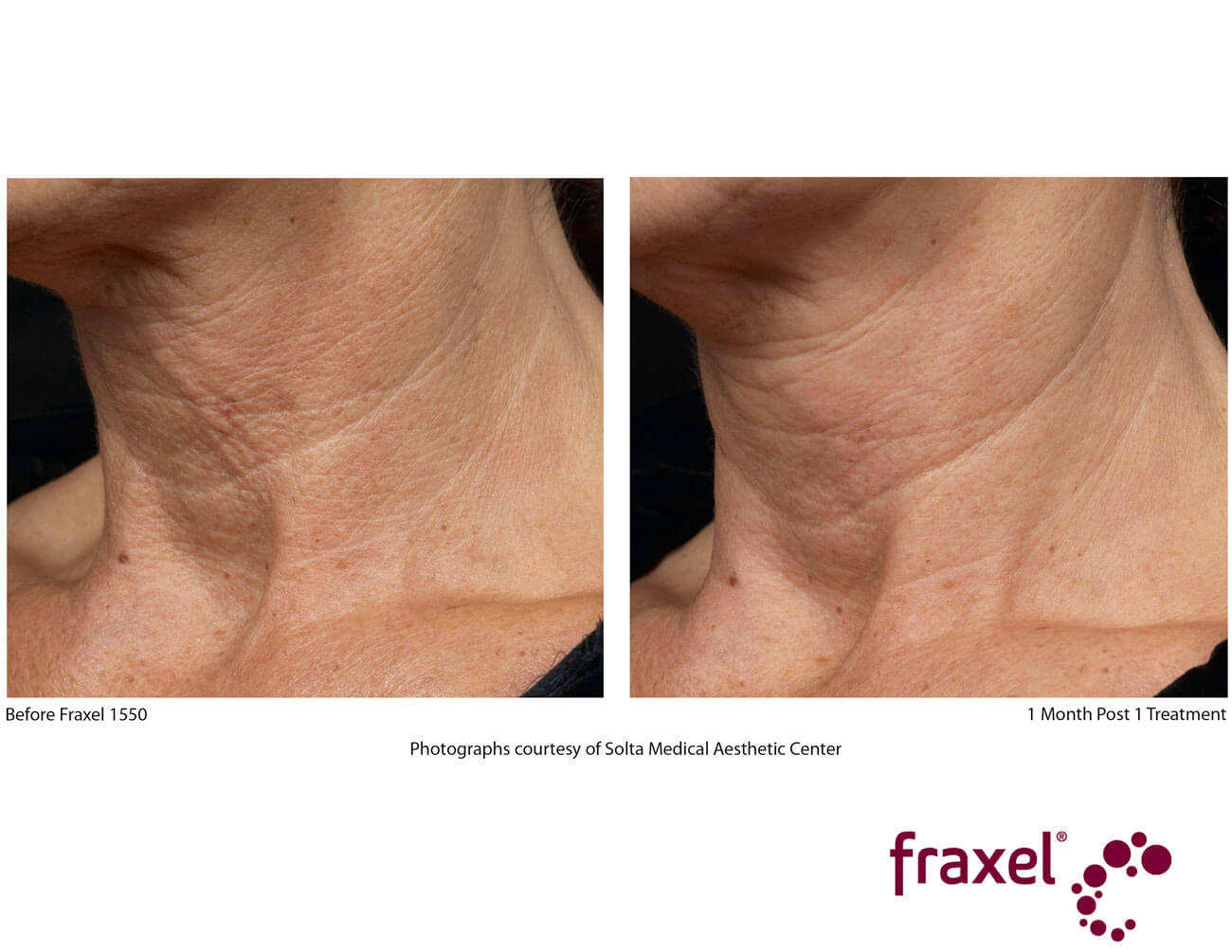 Fraxel® DUAL Cave Creek, AZ Carefree Dermatology