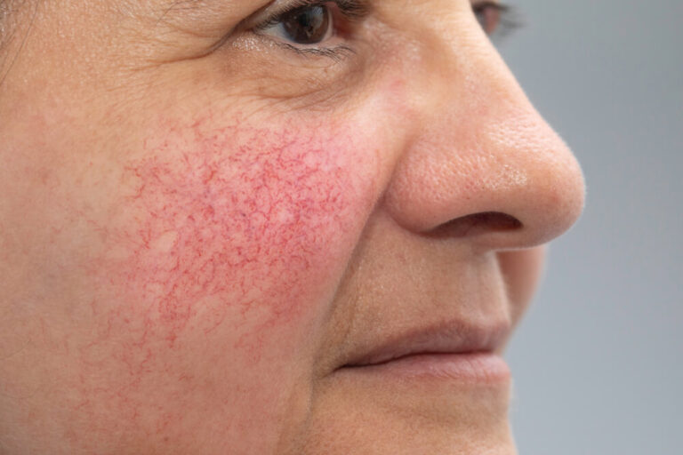 Rosacea Cave Creek, AZ Carefree Dermatology