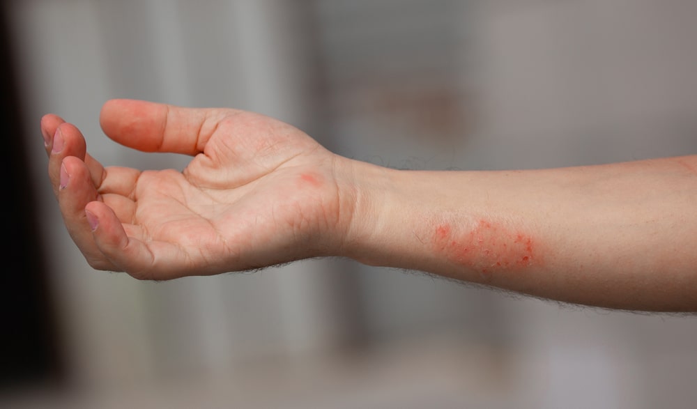 Spots, sores on human skin